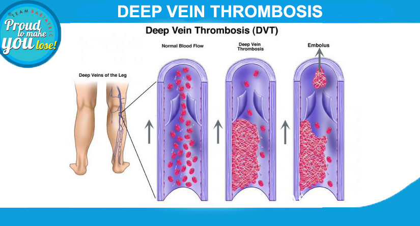 Deep Vein Thrombosis (DVT)