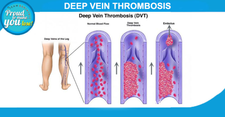 Deep Vein Thrombosis Dvt Symptoms Dvtpe Prevention 5572