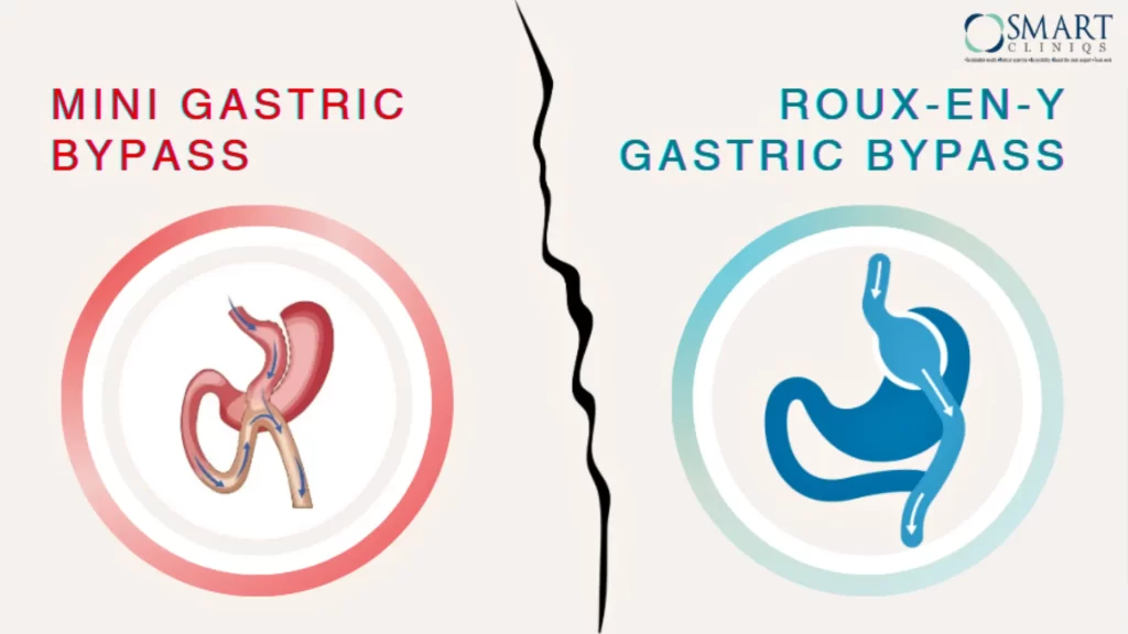 Mini Gastric Bypass vs. Roux-en-Y Gastric Bypass