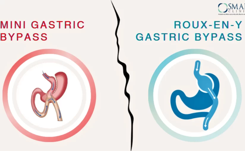 Mini Gastric Bypass vs Roux-en-Y Gastric Bypass