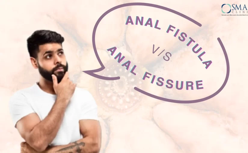 Anal Fistula v/s Fissure