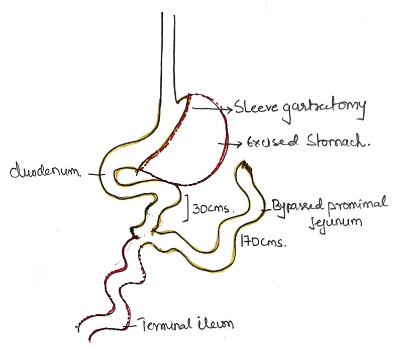 Laparoscopic Sleeve Gastrectomy